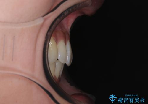 前に飛び出した上顎前歯をスッキリと引っ込める ワイヤー装置での矯正治療の治療後