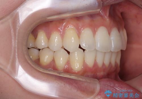 前に飛び出した上顎前歯をスッキリと引っ込める ワイヤー装置での矯正治療の治療後