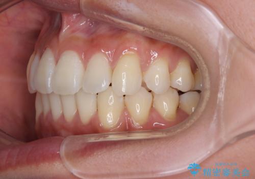 前に飛び出した上顎前歯をスッキリと引っ込める ワイヤー装置での矯正治療の治療後