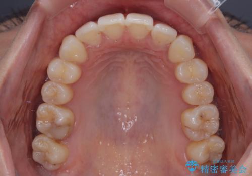 前に飛び出した上顎前歯をスッキリと引っ込める ワイヤー装置での矯正治療の治療後