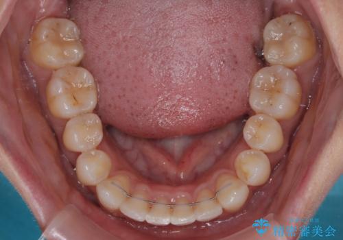 前に飛び出した上顎前歯をスッキリと引っ込める ワイヤー装置での矯正治療の治療後