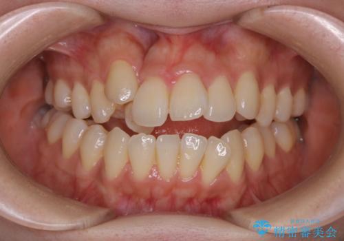 本来は外科ケース:インビザラインで前歯の重度がたつきとオープンバイトの改善の症例 治療前