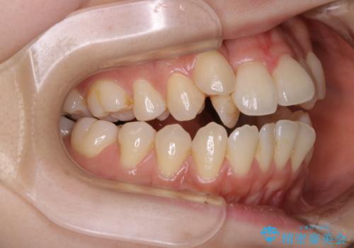 本来は外科ケース:インビザラインで前歯の重度がたつきとオープンバイトの改善の治療前