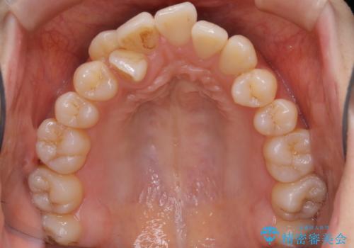 本来は外科ケース:インビザラインで前歯の重度がたつきとオープンバイトの改善の治療前