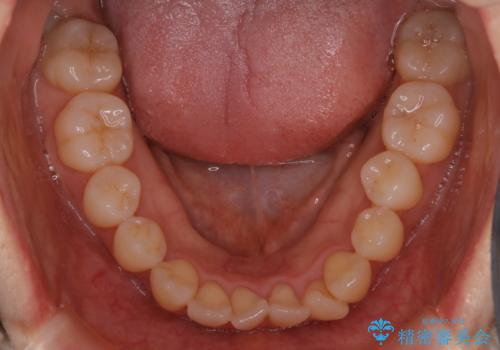 本来は外科ケース:インビザラインで前歯の重度がたつきとオープンバイトの改善の治療前