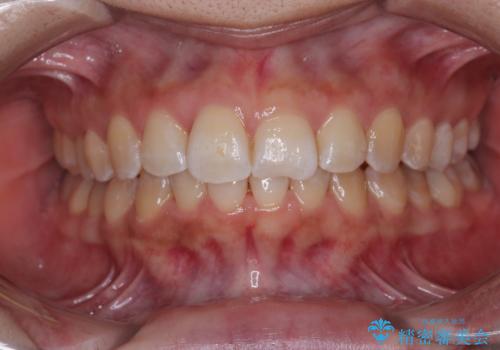前歯のデコボコをインビザライン矯正で綺麗に改善の症例 治療後