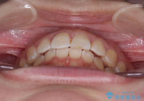 前歯のデコボコをインビザライン矯正で綺麗に改善の治療後