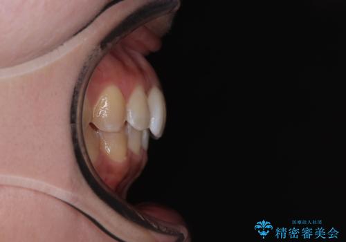 前歯のデコボコをインビザライン矯正で綺麗に改善の治療後