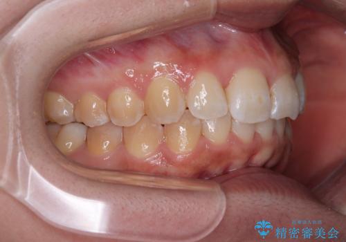 前歯のデコボコをインビザライン矯正で綺麗に改善の治療後