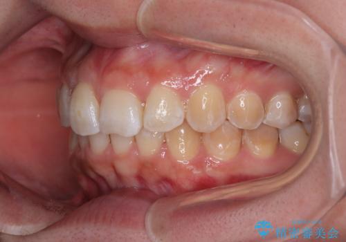前歯のデコボコをインビザライン矯正で綺麗に改善の治療後