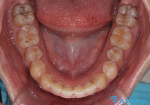 前歯のデコボコをインビザライン矯正で綺麗に改善の治療後
