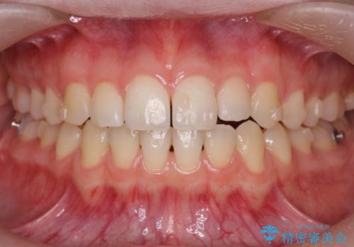 咬んでも前歯が閉じない 矯正治療で見た目を含めて改善の治療中