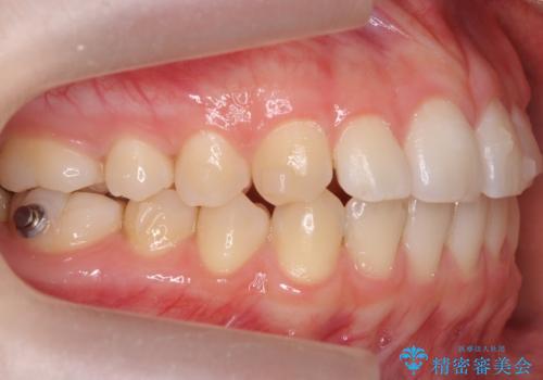 咬んでも前歯が閉じない　矯正治療で見た目を含めて改善の治療中