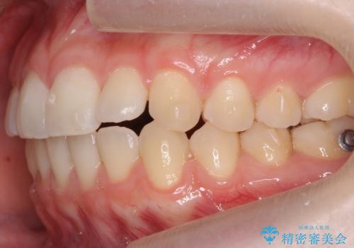 咬んでも前歯が閉じない 矯正治療で見た目を含めて改善の治療中