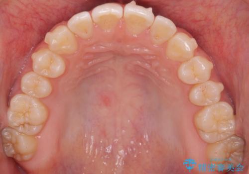 咬んでも前歯が閉じない　矯正治療で見た目を含めて改善の治療中