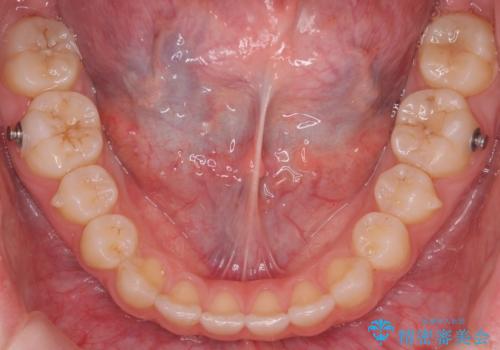 咬んでも前歯が閉じない 矯正治療で見た目を含めて改善の治療中