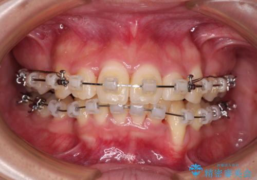 出っ歯を治したい ワイヤー装置での抜歯矯正で劇的変化!の治療中