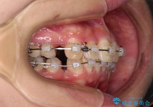 出っ歯を治したい　ワイヤー装置での抜歯矯正で劇的変化!の治療中