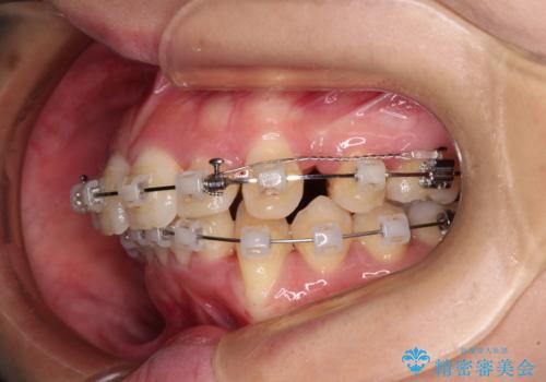 出っ歯を治したい ワイヤー装置での抜歯矯正で劇的変化!の治療中