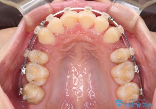 出っ歯を治したい ワイヤー装置での抜歯矯正で劇的変化!の治療中