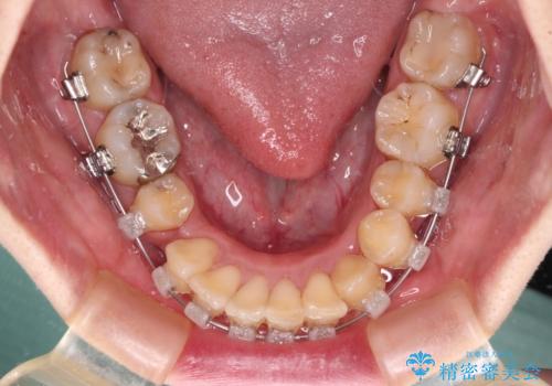 出っ歯を治したい ワイヤー装置での抜歯矯正で劇的変化!の治療中