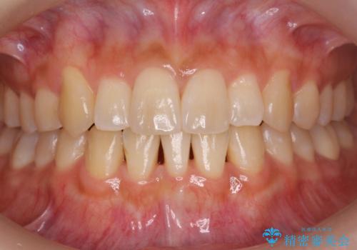 八重歯をインビザラインで　抜歯矯正の症例 治療後