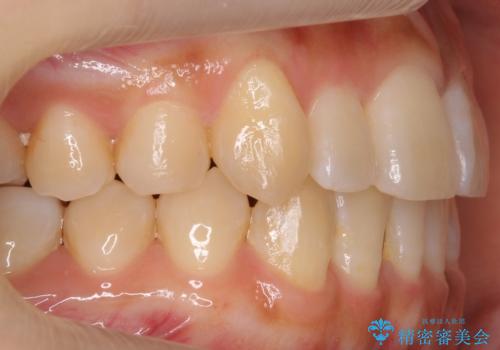 八重歯 インビザラインで抜歯矯正 ただし1本のみの抜歯で済みますの治療後