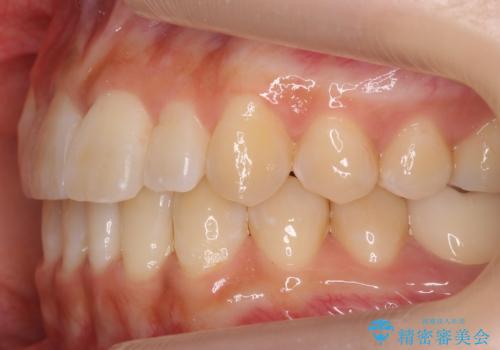 八重歯 インビザラインで抜歯矯正 ただし1本のみの抜歯で済みますの治療後