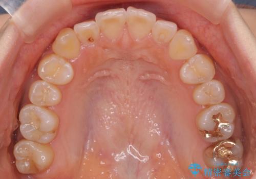 八重歯 インビザラインで抜歯矯正 ただし1本のみの抜歯で済みますの治療後