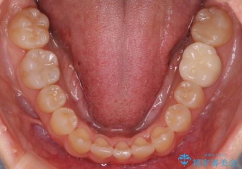 八重歯をインビザラインで　抜歯矯正の治療後