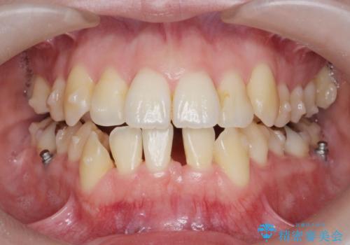 前歯のがたつき すれ違い咬合のマウスピース矯正治療の治療中