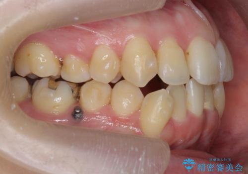 前歯のがたつき　すれ違い咬合のマウスピース矯正治療の治療中