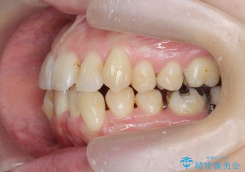 前歯のがたつき　すれ違い咬合のマウスピース矯正治療の治療中