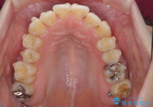 前歯のがたつき すれ違い咬合のマウスピース矯正治療の治療中