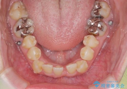前歯のがたつき すれ違い咬合のマウスピース矯正治療の治療中