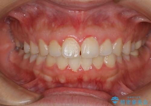 NEW ティオンオフィスホワイトニング(処置前クリーニング込)の治療前