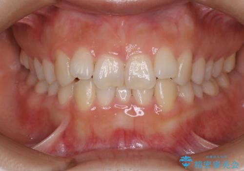 インビザライン矯正　短期間でがたつきのないきれいな歯並びにの症例 治療前