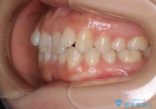 インビザライン矯正　短期間でがたつきのないきれいな歯並びにの治療前
