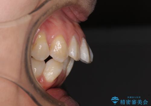 上顎前突で口が閉じにくい　ワイヤー装置での抜歯矯正の症例 治療前