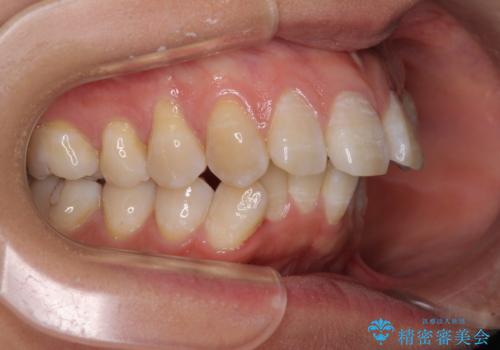 上顎前突で口が閉じにくい ワイヤー装置での抜歯矯正の治療前