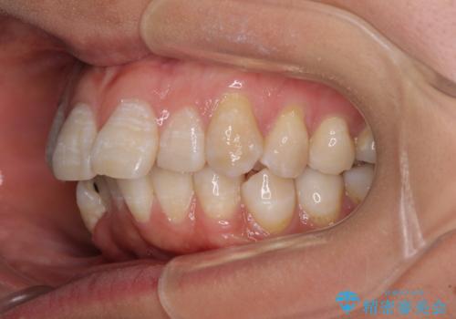 上顎前突で口が閉じにくい ワイヤー装置での抜歯矯正の治療前