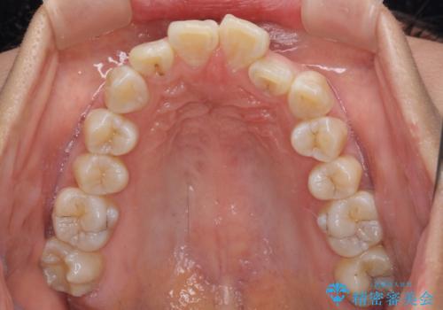 上顎前突で口が閉じにくい　ワイヤー装置での抜歯矯正の治療前