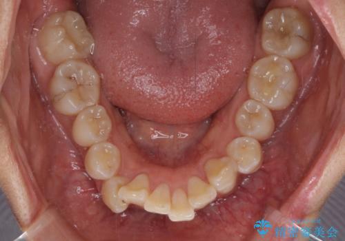 上顎前突で口が閉じにくい　ワイヤー装置での抜歯矯正の治療前