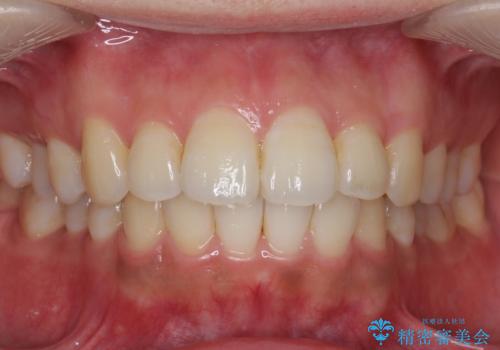 前歯の並び　モニター治療での治療後