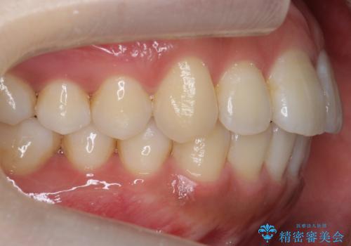 前歯の並び モニター治療での治療後