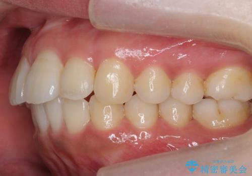 前歯の並び モニター治療での治療後