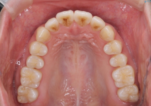 前歯の並び モニター治療での治療後