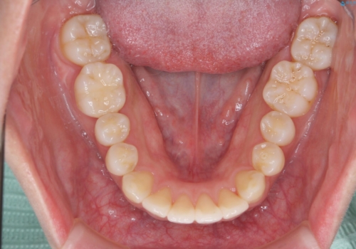 前歯の並び モニター治療での治療後