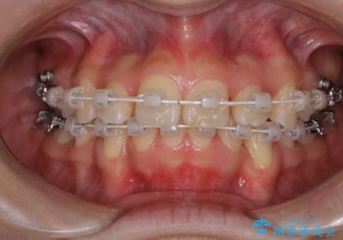 出っ歯と深い噛み合わせ:抜歯矯正で口元スッキリ!の治療中