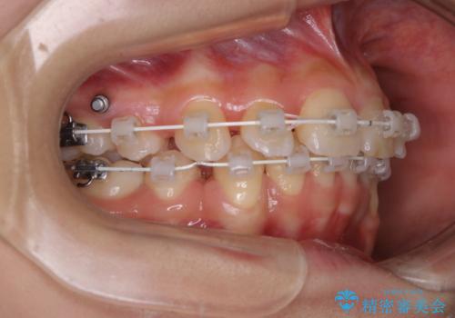 出っ歯と深い噛み合わせ:抜歯矯正で口元スッキリ!の治療中